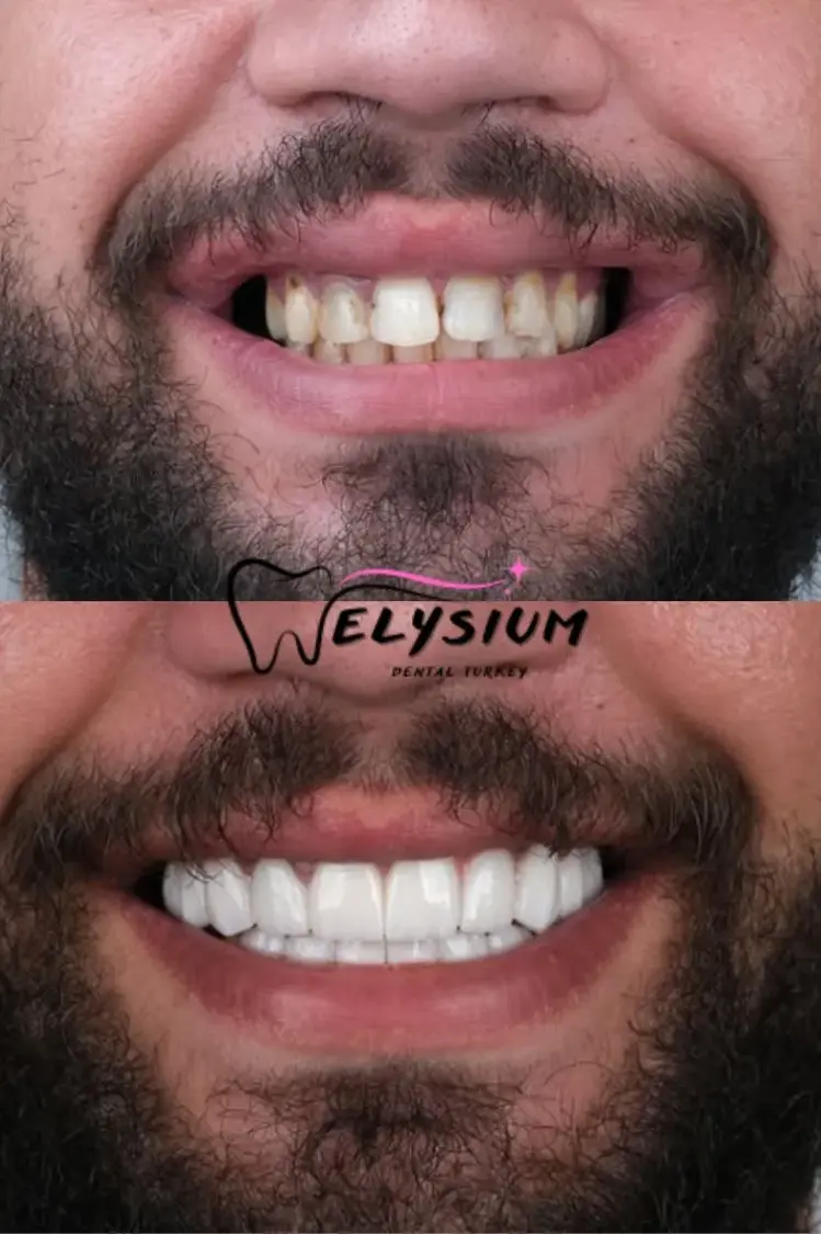 Antalya digital smile design