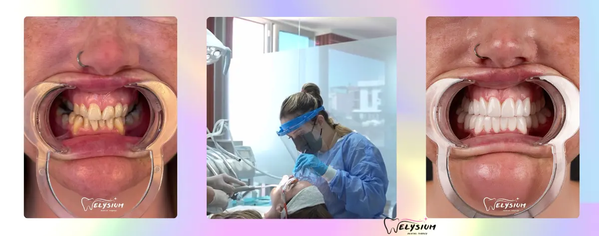 Various Dental Needs Antalya Turkey Various Dental Needs Antalya Turkey