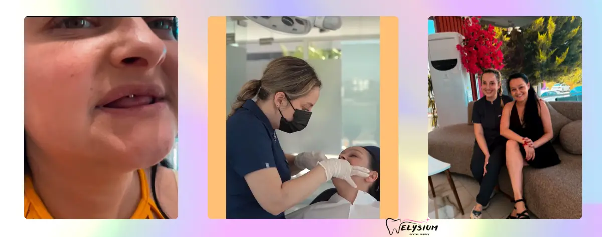 All on 6 dental implants Antalya All on 6 dental implants Antalya