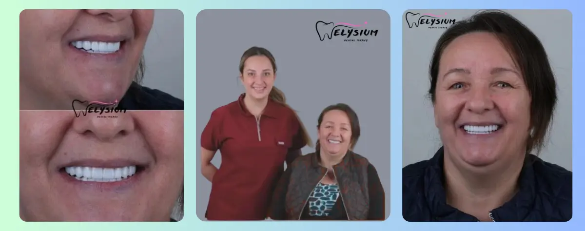 Private Dental Treatment Price List Antalya Turkey