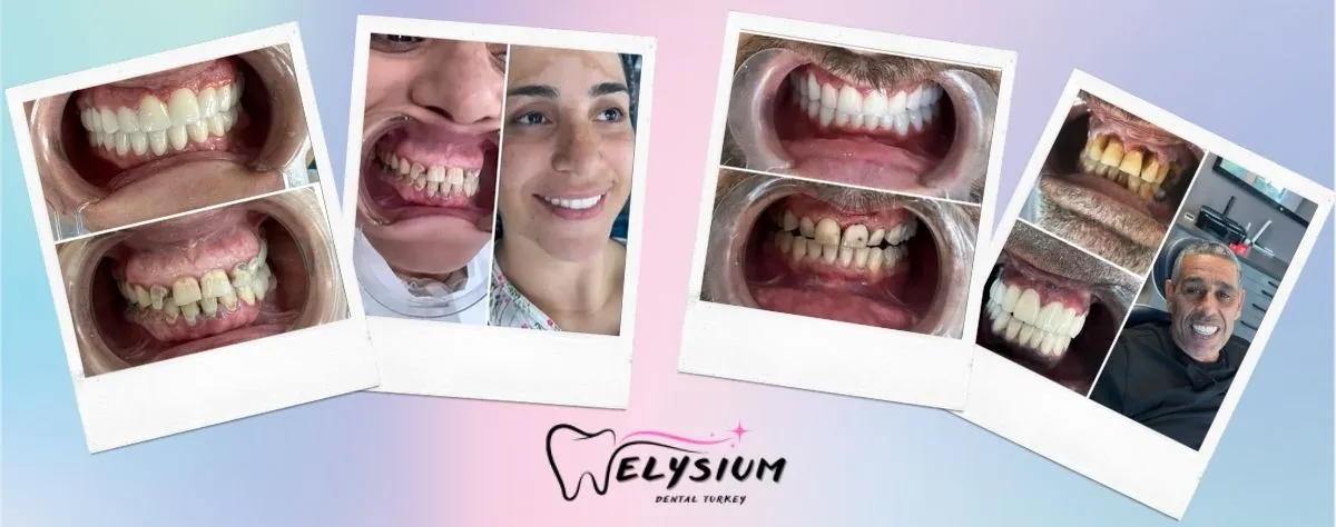 Zirconium crowns before after Antalya Turkey Zirconium crowns before after Antalya Turkey
